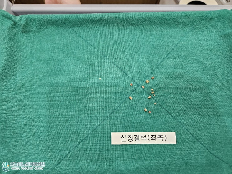 달성군 다사 요로결석 수술, 통증이 갑자기 찾아온다면? (요관결석 케이스) : 네이버 블로그