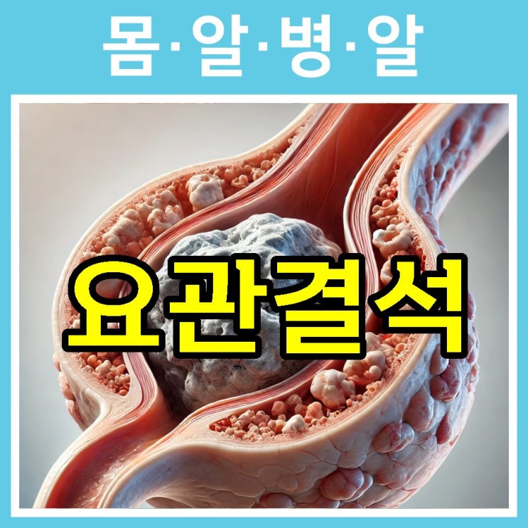 요관결석, 원인 증상 치료 및 예방 방법까지 총정리 : 네이버 블로그