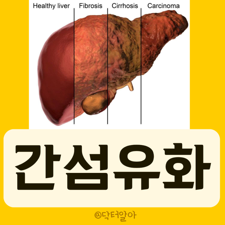 간섬유화의 비침습적 검사: APRI, FIB-4, Fibroscan : 네이버 블로그