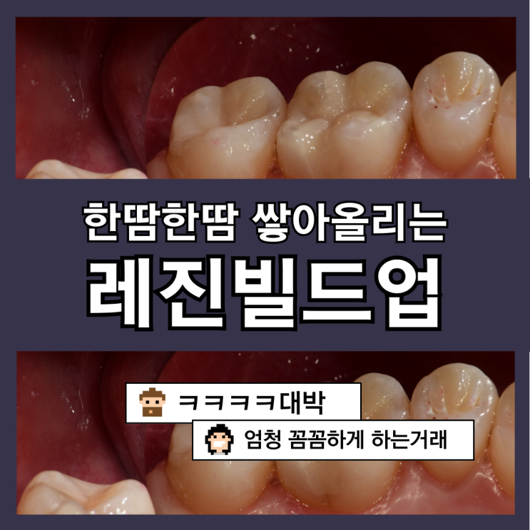 부평충치치료, 레진으로 할래? 인레이로 할래? [부평레진빌드업, 부평레진치료잘하는곳, 치과레진의종류]