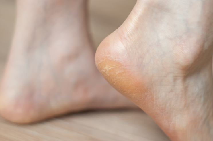 발 뒷꿈치 발바닥 각질제거제 신경 덜쓰는 각질제거 : 네이버 블로그