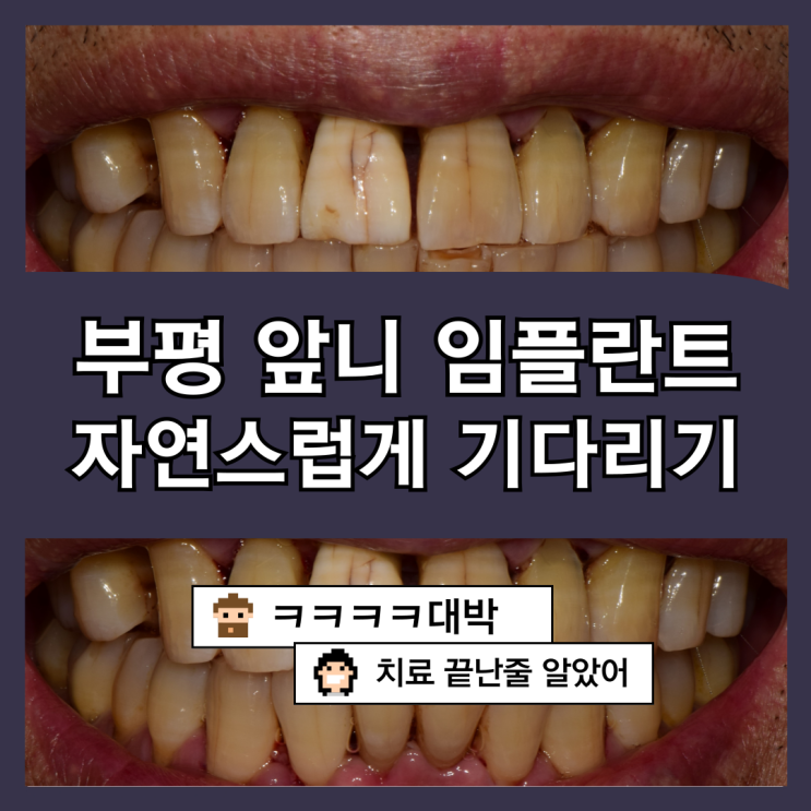 앞니 임플란트, 자연스럽고 예쁘게 기다리기 [부평 앞니임플란트, 임플란트 임시치아, 부평보존치과]