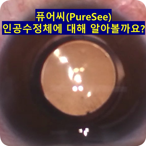 퓨어씨(PureSee) 인공수정체에 대해 알아볼까요? : 네이버 블로그