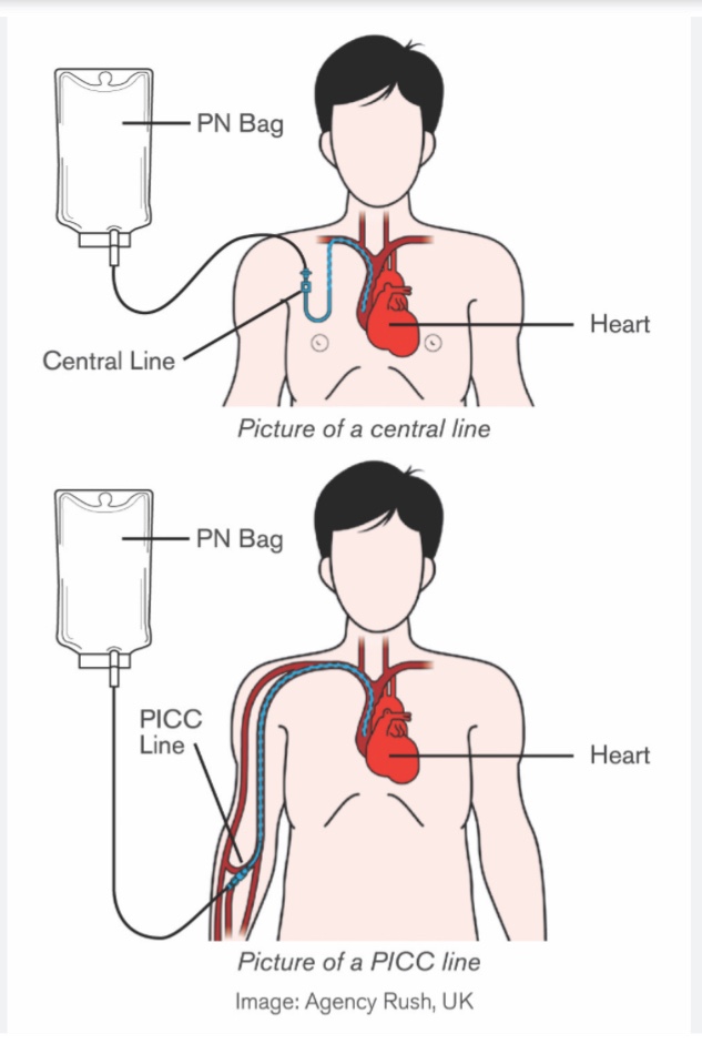 TPN 수액 종류 공부하기 (Total Parenteral Nutrition) : 네이버 블로그