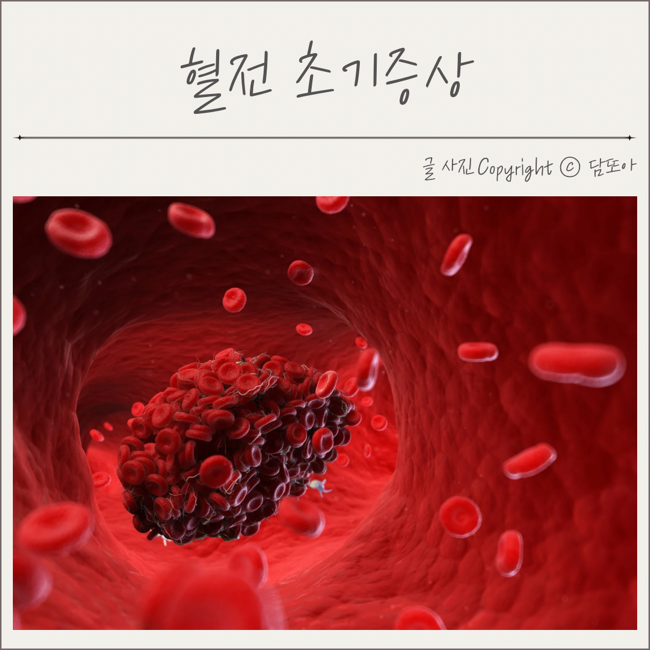 혈전 초기 증상 검사 색전증 치료 : 네이버 블로그
