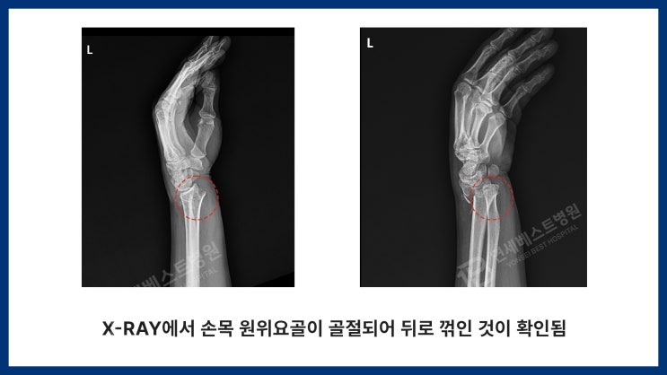 손목 원위 요골 골절 수술 사례 [의정부 연세베스트병원] : 네이버 블로그