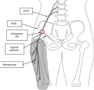 외측 대퇴피부신경(LFCN : Lateral femoral cutaneous nerve) 손상과 Meralgia ...