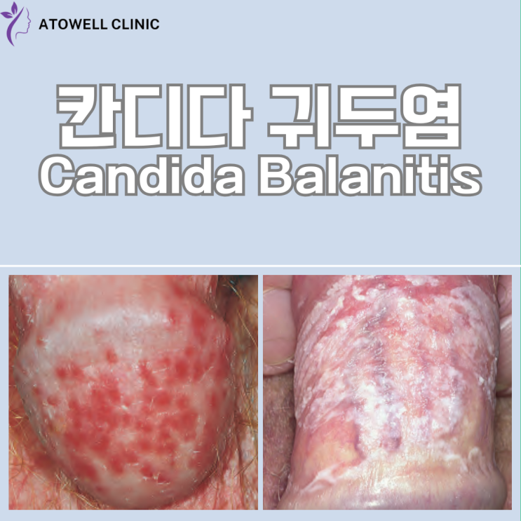 칸디다 귀두염(Candida Balanitis): 증상·치료·예방법 총정리 ㅣ 경주귀두염 ㅣ피부과추천 : 네이버 블로그