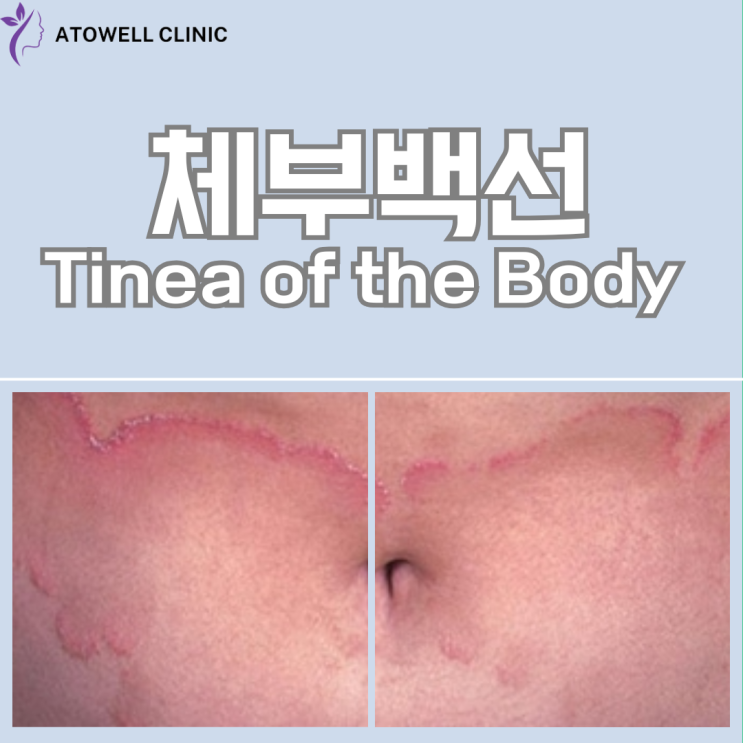 경주무좀, 체부백선(Tinea Corporis): 증상부터 치료·예방까지 한눈에 정리 ㅣ경주체부백선치료 ㅣ피부과추천 : 네이버 블로그