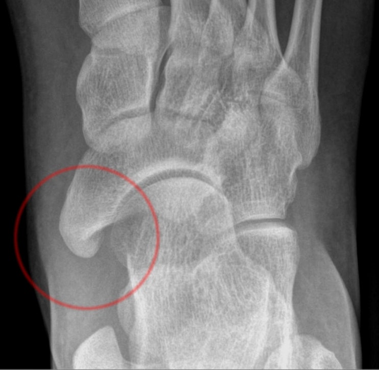 부주상골 제거술 및 후경골근건 봉합술 (Accessory Navicular Excision & Posterior Tibial ...