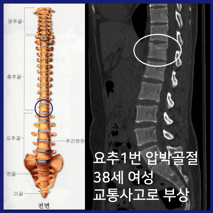 요추1번 압박골절 영상비교 [척추골절 부위별 비교] : 네이버 블로그