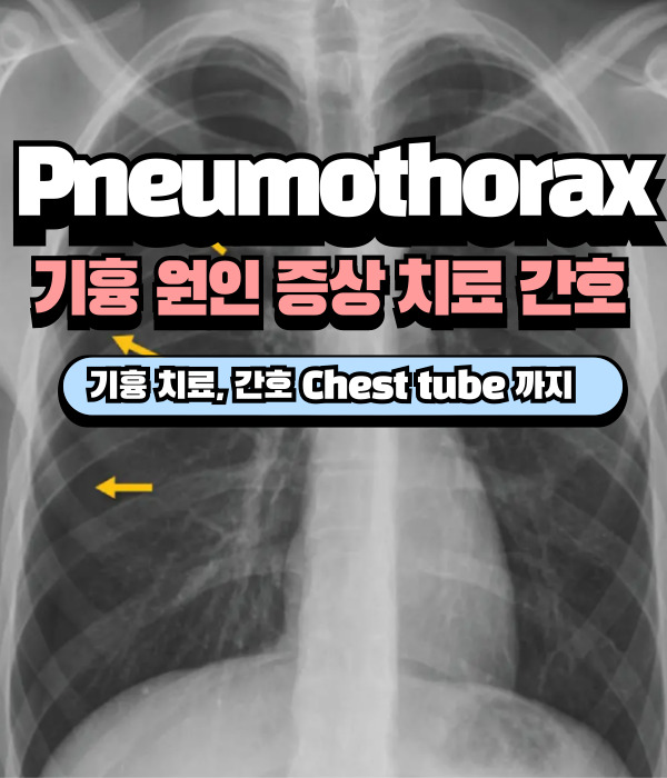 Pneumothorax 기흉 종류, 원인, 증상, 치료, 간호 (CTD 흉관 삽입) : 네이버 블로그