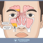 임플란트 하기 전 반드시 축농증 검사부터