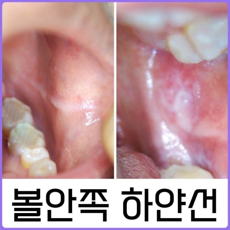 볼 안쪽에 하얀 선이 생겼어요.(협점막 백선, 구강 편평태선) : 네이버 블로그
