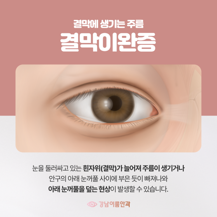 강남역 안과 결막 이완증 원인과 치료방법 : 네이버 블로그