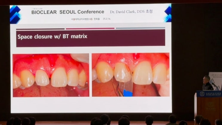 Bioclear Injection Molding Composit restoration Bioclear Method : 네이버 블로그