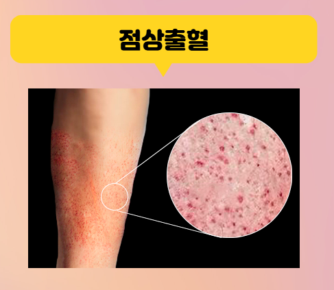 점상출혈, 왜 생길까? 원인과 대처법 : 네이버 블로그