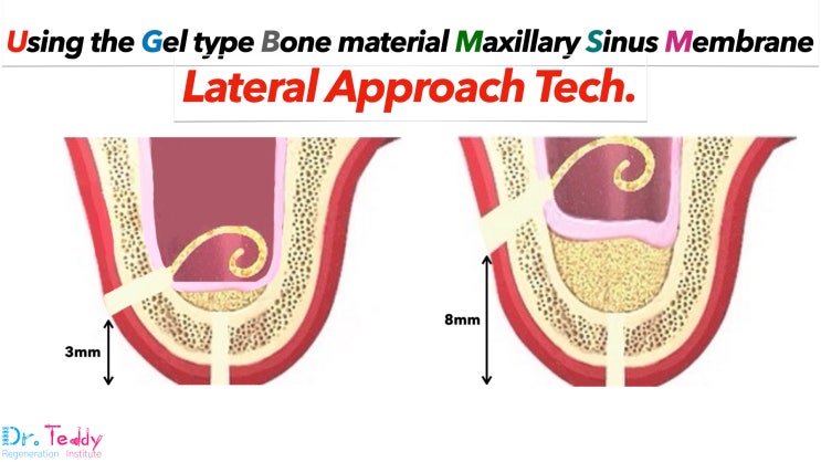 Lateral Approach using ExcelOs Inject 1.5g : 네이버 블로그