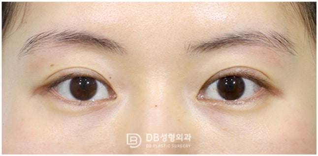 세땀매몰 쌍꺼풀풀림 재수술 일부만 바꾸고 싶다면 : 네이버 블로그