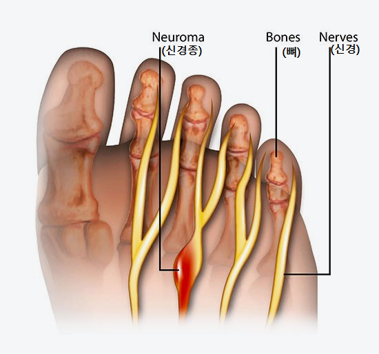지간신경통(趾間神經痛 interdigital neuroma) : 네이버 블로그