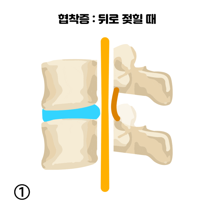 신경인성 파행(neurogenic claudication) 이란? : 네이버 블로그