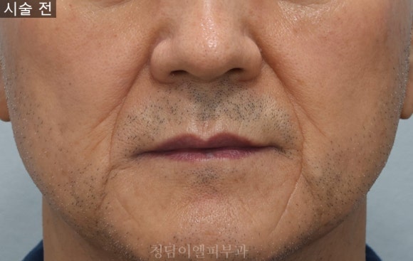 진피재생술 부위별 전후사진&주의사항 : 네이버 블로그