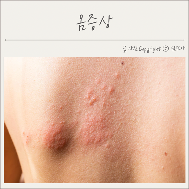 옴증상 옴치료법 가려움증 완화 : 네이버 블로그