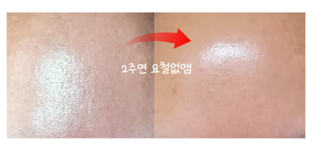 지긋지긋한 피부 요철 없애는 방법 후기 : 네이버 블로그