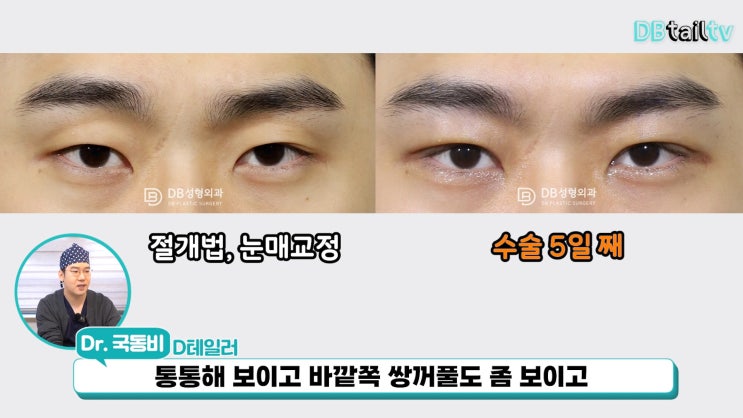 남자쌍커풀수술 절개 후 붓기 직후부터 한 달까지 사진 비교 : 네이버 블로그