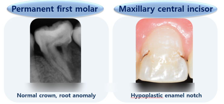 우리 아이 치아가 이상해요. MRIM(Molar Root Incisor Malformation) : 네이버 블로그