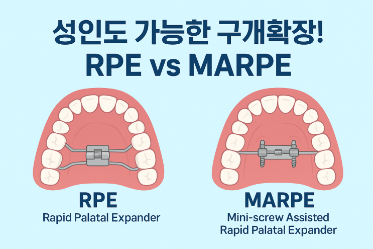 성인도 가능한 악궁확장장치! RPE vs MARPE 완벽 비교 | 서울나란이치과 김광유 원장 : 네이버 블로그