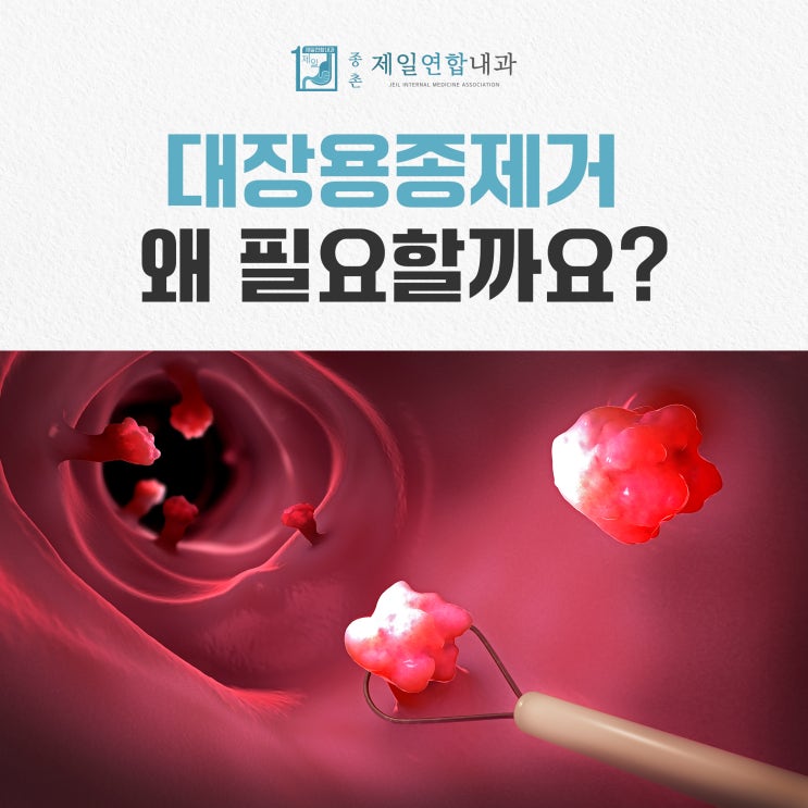 세종시 아름동내과 대장 용종 제거의 필요성 : 네이버 블로그