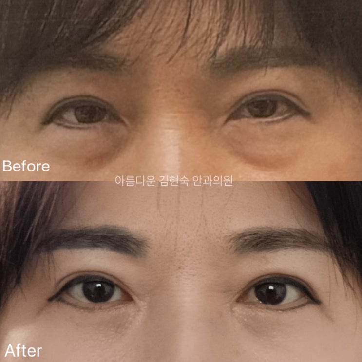 전주 아름다운 김현숙안과 50대 하안검 수술 후기 : 네이버 블로그