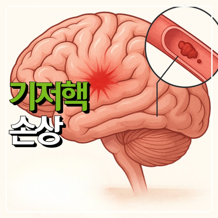기저핵 위치와 손상 출혈 석회화 되었을때 : 네이버 블로그