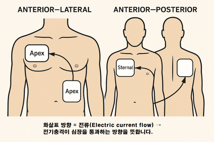 DC Shock의 종류와 적용 차이 – Defibrillation과 Cardioversion 완전정리 : 네이버 블로그