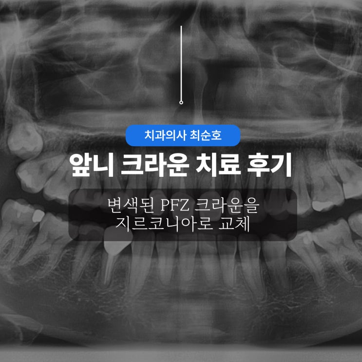 앞니 크라운 치료 후기 변색된 PFZ 크라운을 지르코니아로 교체 : 네이버 블로그