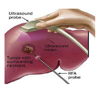 간암의 고주파 열치료술(Radiofrequency Ablation, RFA)이란 무엇인가? : 네이버 블로그