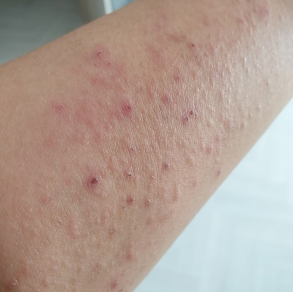 옴 초기증상 원인과 진드기 감염 관리 방법 : 네이버 블로그