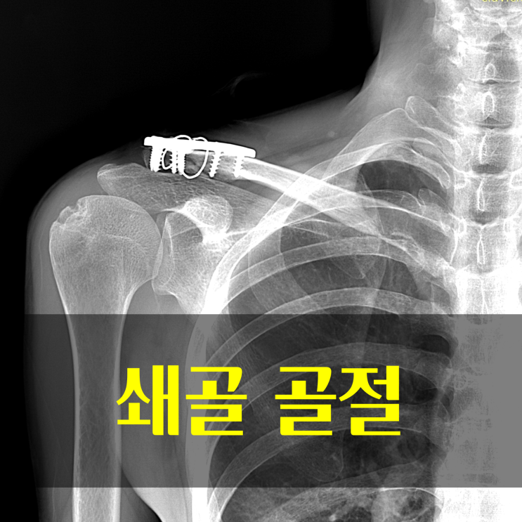 쇄골 골절 수술 후 언제쯤 회복할 수 있을까요? (feat 접골탕 2.0) : 네이버 블로그
