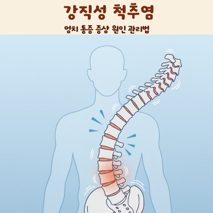 강직성 척추염 엉치 통증 증상 원인 관리법 : 네이버 블로그
