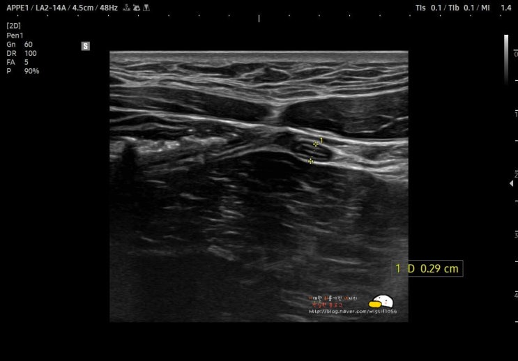 충수 초음파 검사 Normal appendix : 네이버 블로그