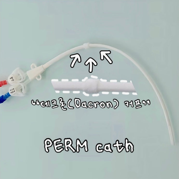 투석 카테터인 Q cath(Quinton catheter)와 PERM cath(Permenant catheter) 의 차이점 ...