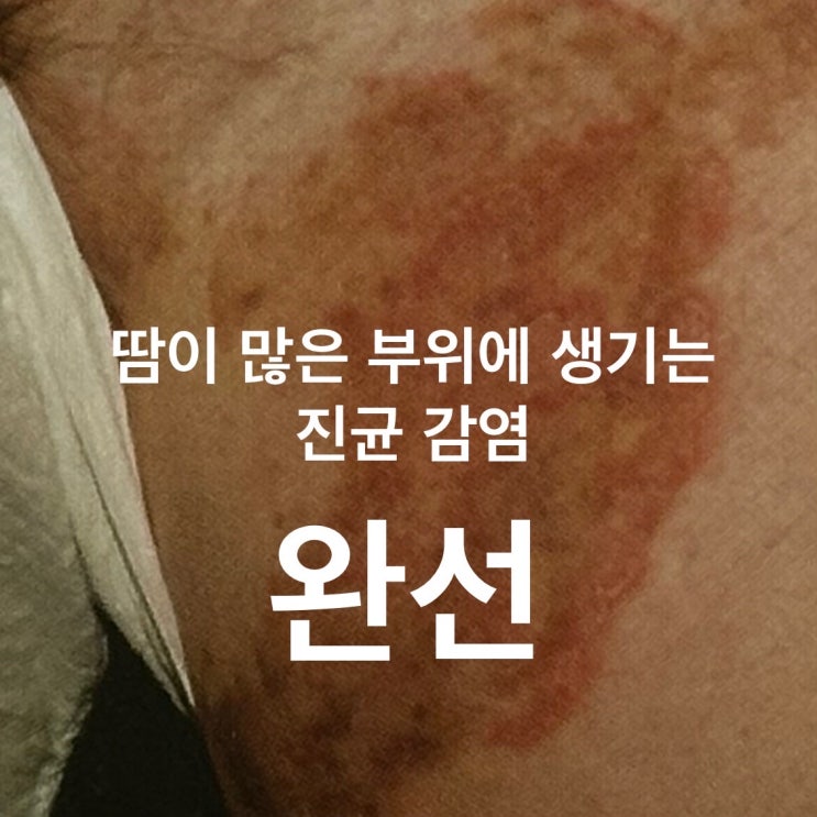 대구 사타구니 백선 완선 치료 원인 증상까지 칠곡 장재원 피부과 의원 : 네이버 블로그