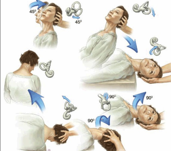 이석정복술 (Epley Maneuver): 이석증을 10분 만에 고치는 기적의 자세 치료법 : 네이버 블로그