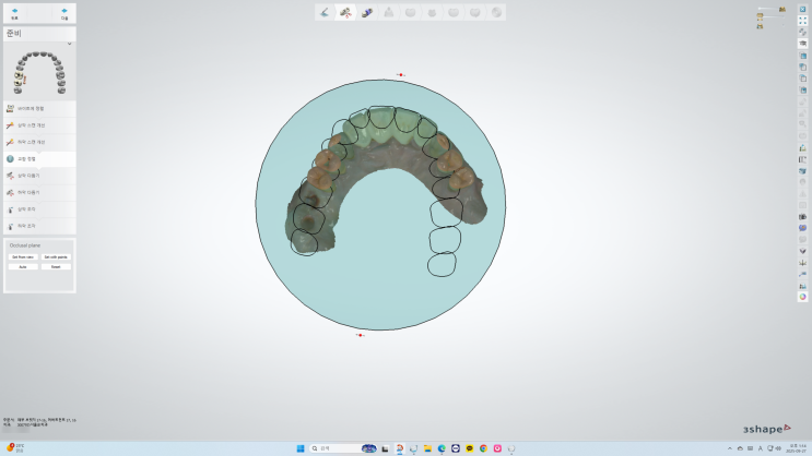 3shape dental system을 이용한 TS R 임플란트 크라운 디자인 : 네이버 블로그
