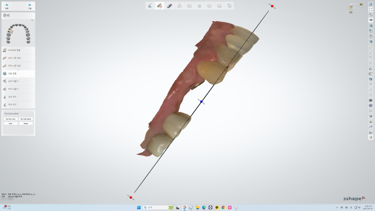 3shape dental system을 이용한 TS R 임플란트 크라운 디자인 : 네이버 블로그