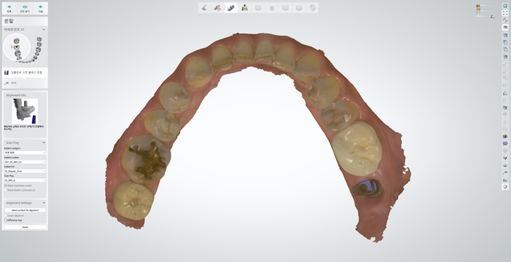 3shape dental manager를 이용한 오스템 SS regular 디자인 : 네이버 블로그