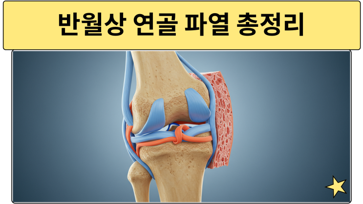 반월상연골파열, 성인 61%가 통증 없이 찢어져 있는 이유! : 네이버 블로그
