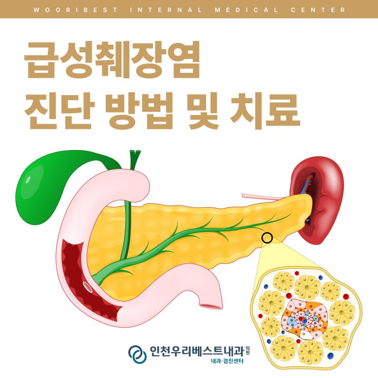 급성췌장염 진단 방법 및 치료 : 네이버 블로그