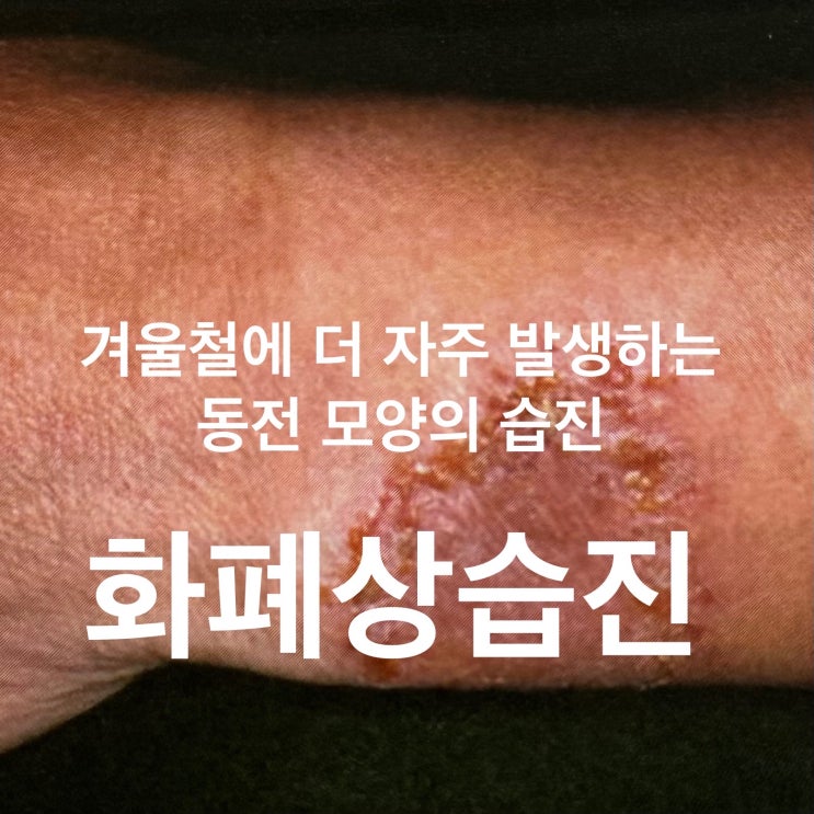 대구 칠곡피부과 화폐상 습진 동전피부염 치료 원인 증상까지, 장재원 피부과 의원 : 네이버 블로그